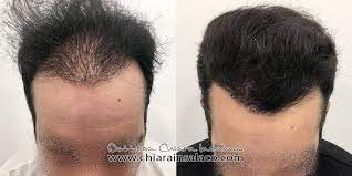 best hair clinics hair transplant