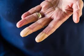 numbness in fingers hands 13 causes
