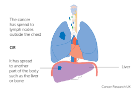 Most people with lung cancer don't have symptoms until the cancer is advanced. Stage 4 Lung Cancer Cancer Research Uk