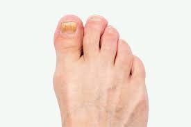 fungal nail infection onychomycosis