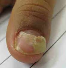onychomadesis fingernail and toenail