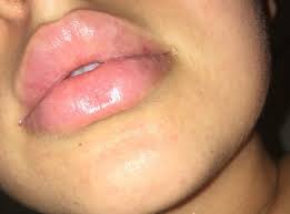 pale lips after lip fillers is this