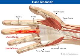 Image result for tendonitis