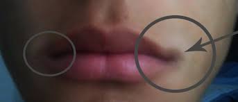 dark lip corners and hydroquinone