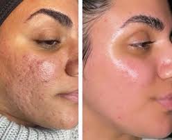 morpheus8 treatment for acne scars