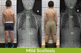 mild scoliosis symptoms treatment