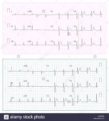 Heart Cardiogram Chart Vector Set Healthy Heart Rhythm