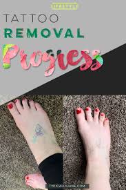 tattoo removal before and after in