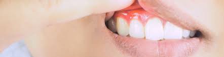 what actually causes gum disease and