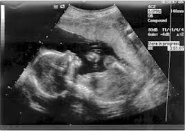 Image result for down syndrome ultrasound pictures