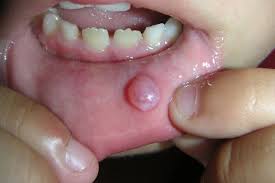 mucocele mucus cyst symptoms causes