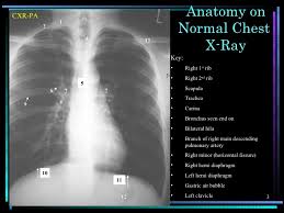 An online course by lee herrington. Chest X Ray Anatomy