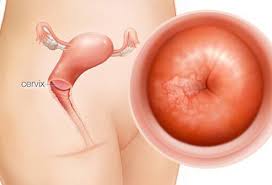 Cervical cancer is a cancer of the female reproductive system affecting the cervix. Cervical Cancer Symptoms Stages And Treatment
