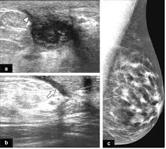 Originally observed image and makes the filters behave like an all Inflammatory Breast Disease The Radiologist S Role Sciencedirect