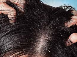 dandruff leads to hair loss how does