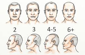 Hair Transplant Timeline What Can You Expect Hairguard