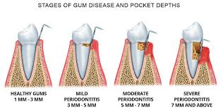 Treatment For Gum Disease In Dallas Periodontal Associates