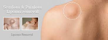 lipoma removal surgery in pune fatty