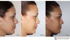 rhinoplasty swelling months and years