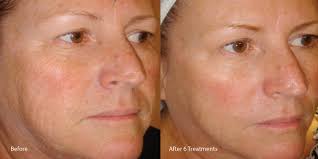 combination microdermabrasion