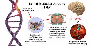 spinal muscular atrophy pathophysiology