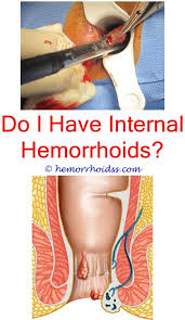 Other factors such as degree of discomfort, bleeding, comorbidities, and patient preference should help determine. How To Apply Witch Hazel To Hemorrhoids Home Remedies For Hemorrhoids Thrombosed Hemorrhoid Hemorrhoids Treatment