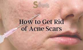 how to get rid of acne scars