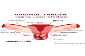 yeast infection during pregnancy