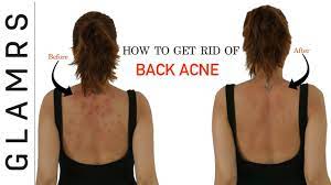 how to get rid of back acne the natural