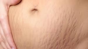 stretch marks with skin colored ink