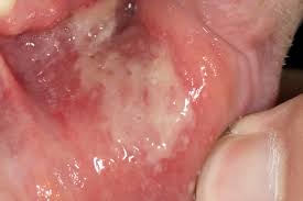 Dabei verursachen herpesviren schmerzhafte bläschen im mund. Rezidivierende Stomatitis Aphtosa Zahn Mund Kieferkrankheiten Msd Manual Profi Ausgabe