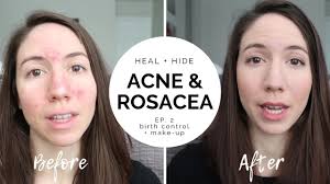 heal hide severe acne rosacea