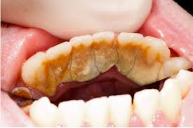 plaque vs calculus 209 nyc dental