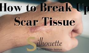 how to break up scar tissue bakersfield