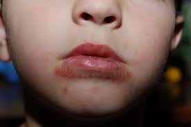 15 common skin rashes in children