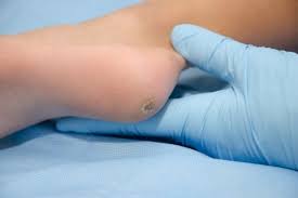 plantar wart treatment with lasers for