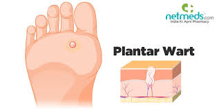plantar wart foot wart causes