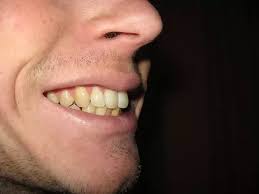 Thus usually includes extraction and reshaping the lower teeth through veneers. Ways To Correct Overbite Without Braces
