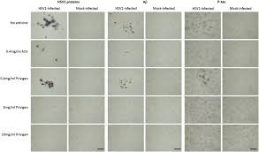 Intravenous Immunoglobulin Reduces Beta Amyloid And Abnormal