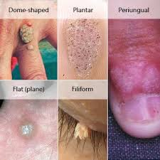Apply wart removal medication if you want to speed up the process. Common Wart Removal Tips Treatments Home Remedies