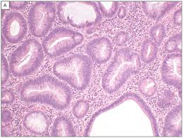 Adenoma And Malignant Colorectal Polyp Pathological