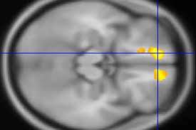 brain scans of children with tourette s