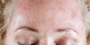 scaly scalp you may have seborrheic