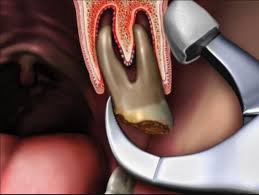 a bone ule after tooth extraction