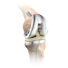 depuy attune knee replacements tibial