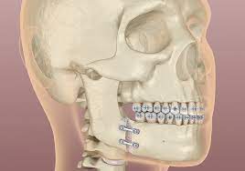 types of corrective jaw surgery