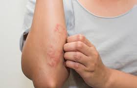 eczema scars 10 effective ways to