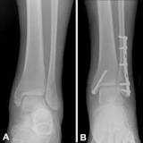 Image result for icd 10 code for displaced bimalleolar fracture left ankle