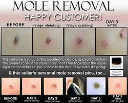 They also include topical treatments with salicylic acid in the form. 11 Before And After Pics Remove Skin Tag Wart Mole Keloid Remover Acid Ebay