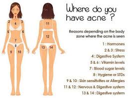 This Body Chart Explains Why Your Acne Keeps Coming Back